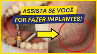 Quais são os cuidados básicos após implante dentário [upl. by Nat443]