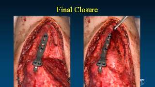 Fixation Options and Techniques for Distal Humerus Fractures VuMedi [upl. by Lightman714]