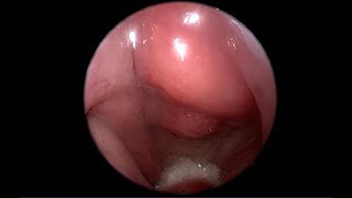 Nasopharyngeal Carcinoma NPC Endoscopic View of Nasopharynx Versus Normal [upl. by Naziaf958]