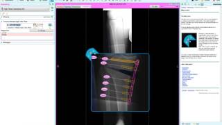 High Tibial Osteotomy HTO 2  Deformity Correction Planning  Materialise OrthoView [upl. by Chitkara363]