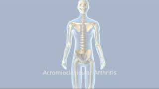 Acromioclavicular Arthritis [upl. by Rodmur324]