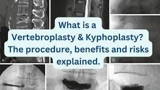 What is a Vertebroplasty amp Kyphoplasty The procedure benefits and risks explained [upl. by Lucien]