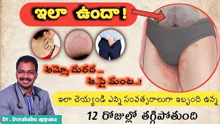 HOW TO GET RID SKIN PROBLEM AT GROIN REGION  skin treatment fungal infection dr dorababu appana [upl. by Stella]