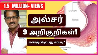 அல்சர்வயிற்றுப்புண் 9 அறிகுறிகள் என்ன கண்டுபிடிப்பது எப்படி Ulcer Symptoms amp Diagnosis [upl. by Yole546]