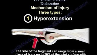 PIP Dorsal Fracture Dislocation  Everything You Need To Know  Dr Nabil Ebraheim [upl. by Gunn]