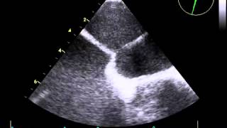 Video 1672 Interventional Cardiac Electrophysiology [upl. by Rehttam]