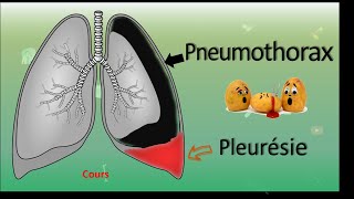 💨 Pneumothorax 🆚 Pleurésie 💧  Cours  PneumoPhtisiologie [upl. by Postman361]