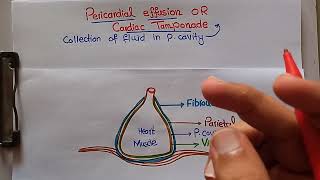 Pericardial Effusions or cardiac tamponade cause aspirationdrainage techniques [upl. by Pierson817]