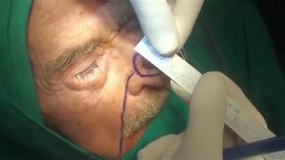 nasolabial island flap for nasal skin reconstruction [upl. by Nueoht]