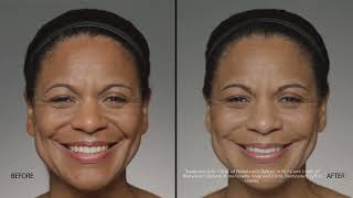 Restylane Dermal Filler  gorgeous [upl. by Cadmann]