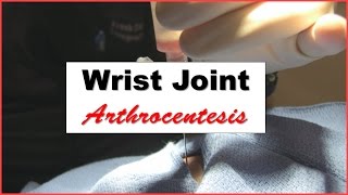 Wrist Joint Arthrocentesis Procedure [upl. by Eesdnyl435]