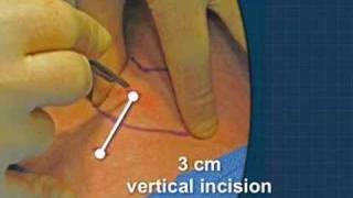 Cricothyrotomy [upl. by Greyso316]