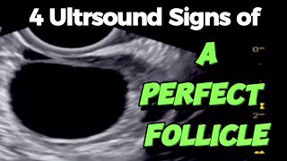 A Perfect Follicle  4 Ultrasound Signs  of Good Follicle for Easy Conceiving [upl. by Atenahs]