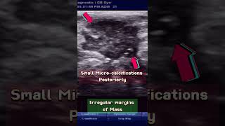 Breast mass  Cancer   Early Diagnosis ultrasound breastcancer mass [upl. by Leiuqeze]