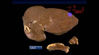 pathology  dr Dhaymaa  Liver Pathology  Alcohol Hemochromatosis  Wilson Tumors  الكبد [upl. by Lianna]