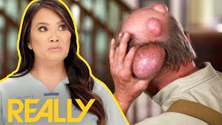 Pimple popping videos of 2021  Squeezing exploding acne Compilation [upl. by Julienne]