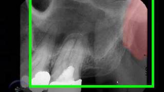 Proceso pterigoideo y apofisis hamular Pterygoid Plateshamular process [upl. by Lippold]