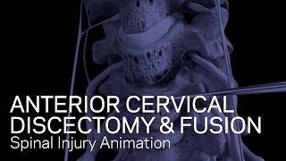 C56C67 Anterior Cervical Discectomy with Fusion [upl. by Leiad419]