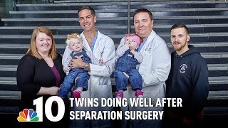 Girls Conjoined at the Head Doing Well a Year After Separation Surgery [upl. by Inglebert54]