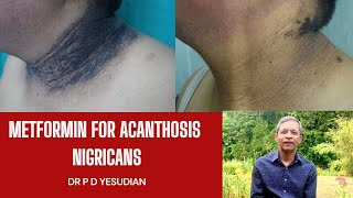 Oral metformin for acanthosis nigricans [upl. by Roche813]