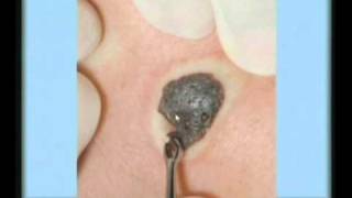 Seborrheic Keratosis Treatment [upl. by Imarej]