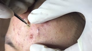 How To Remove Blackheads And Whiteheads On Face Easy 59 ✦ Dr Laelia ✦ [upl. by Nagard460]