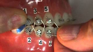 Orthodontic Jaw Wiring in the Dental Professional Office [upl. by Meehan]