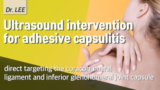 US intervention for adhesive capsulitis targeting coracohumeral ligament and inferior capsule [upl. by Lucrece]