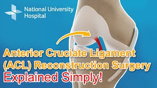 Anterior Cruciate Ligament ACL Reconstruction Surgery  Explained [upl. by Negaet]