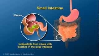 What is an Ileostomy [upl. by Osher851]