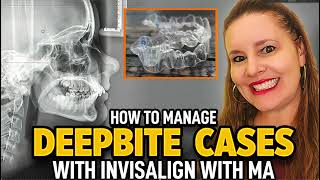 Invisalign with MA Deepbite Cases [upl. by Nnoj]