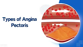 Types of Angina [upl. by Odnuges]