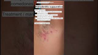 Hidradenitis suppurativa [upl. by Acirret]