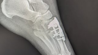 Fracturaluxacion Lisfranc fisioterapia tras intervención quirurgica [upl. by Niatirb670]