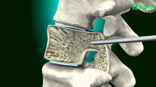 Vertebroplasty amp Kyphoplasty  Spine Surgery Neuro Surgery Fortis HealthcareIndia [upl. by Hube]