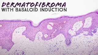 Dermatofibroma with basaloid follicular induction pathology mimic of basal cell carcinoma dermpath [upl. by Yenahc]