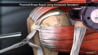 Proximal Biceps Repair using SwiveLock Tenodesis [upl. by Ehcsrop]