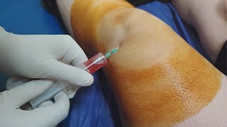 Knee fluid removal  Arthrocentesis  Synovial fluid aspiration procedure [upl. by Lauretta445]