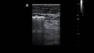 Insertion deployment and laser ablation of Great saphenous Vein shortsvideo [upl. by Luella446]