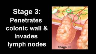 Colon Cancer Diagnosis amp Treatment  Los Angeles Colonoscopy [upl. by Nagar]