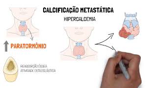 Calcificações patológicas  Distróficas e Metastáticas [upl. by Dinnie19]