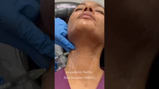 Volite skin booster for tech neck Less injection site swelling than face as skin thicker beauty [upl. by Assirhc]