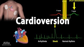 Cardioversion Electrical Procedure Animation [upl. by Lebana896]