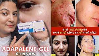 How to Use Adapalene Gel 01  Full Detail Video  Best Gel For Removing Blackheads and Pimples [upl. by Mou937]