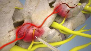 Endoscopic rhizotomy [upl. by Amary]