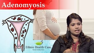 Adenomyosis Treat Naturally Ethnic Health Care Siddha Hospital [upl. by Palma]