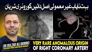 Very Rare Anomalous Origin Of Right Coronary Artery  Rare Heart Condition  By DrGulzar Ali Buriro [upl. by Eramat]