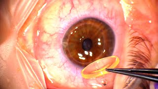 Corneal Transplant Penetrating Keratoplasty for Advanced Keratoconus and Corneal Infiltrates [upl. by Sasnett379]