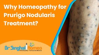 Homeopathic Treatment for Prurigo Nodularis with Effective Results  Dr Singhal homeo HomeoDoctor [upl. by Atsirtal]