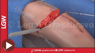 Above the Knee Amputation Surgery 3D animation [upl. by Gleda]